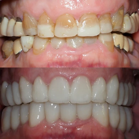 Dentist-Cottonwood-Heights-UT-Cosmetic-Dentistry-BOX-Before-and-After